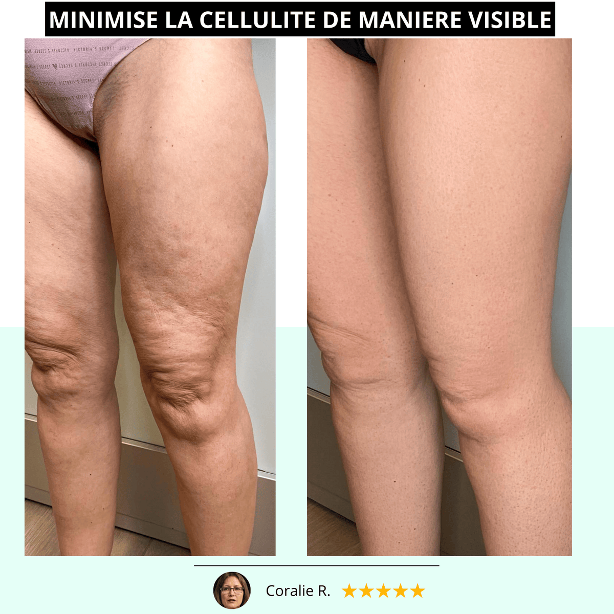 VIBRAPRO - Appareil Anti-Cellulite & Brûle-Graisse